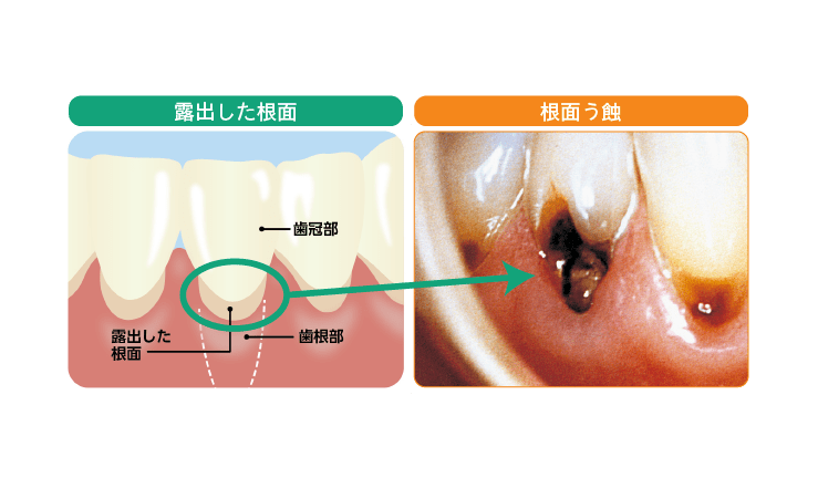 根面治療